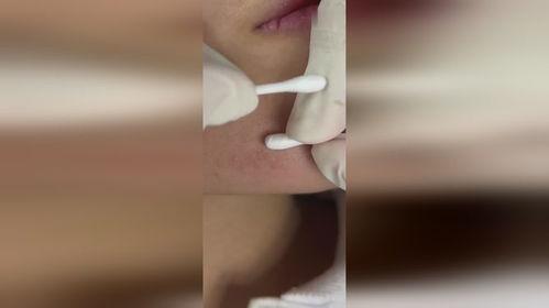 挤痘痘挤视频,视频带你直击“战痘”现场
