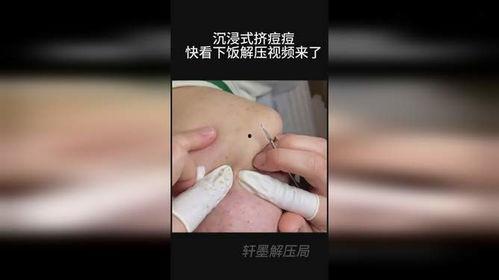挤痘痘挤视频,视频带你直击“战痘”现场