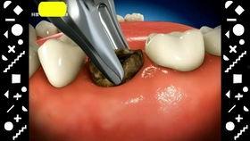 种植牙的过程视频,从术前评估到术后护理